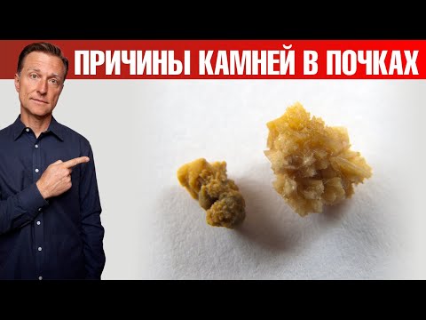 Обнаружена главная причина камней в почках | Dr. Berg - официальный русскоязычный канал