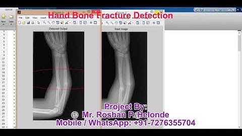 Matlab Project on Hand Bone Fracture Detection using Image Processing