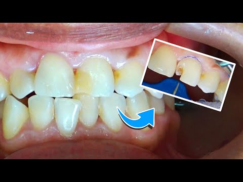 Реконструкция зубов с полостями