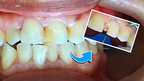 ¿Pueden repararse los dientes?