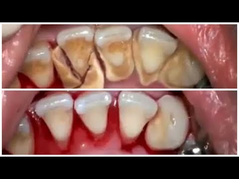 Cara Merontokkan Karang Gigi Dengan CEPAT Secara ALAMI