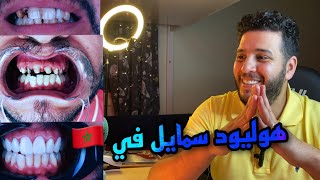 كنت غدي نكون ضحية هوليود سمايل في إسطنبول Hollywood Smile Maroc Snap On Smile