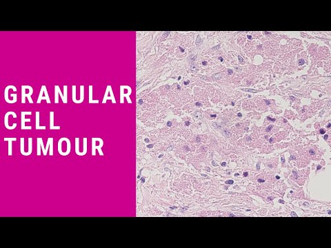 Granular Sel Tumor - Patologi Mini tutorial