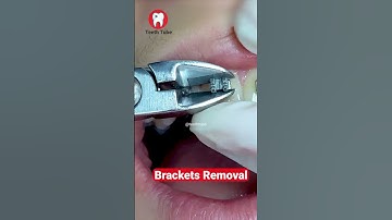 Brackets Removal #shorts