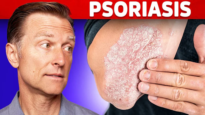 Psoriasis Treatment – The Best 3 Remedies for Psoriasis – Dr.Berg - DayDayNews