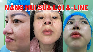 Nâng mũi sửa lại A-line giải pháp cho những trường hợp mũi bóng đỏ, lộ sụn...|Bác sĩ Trọng