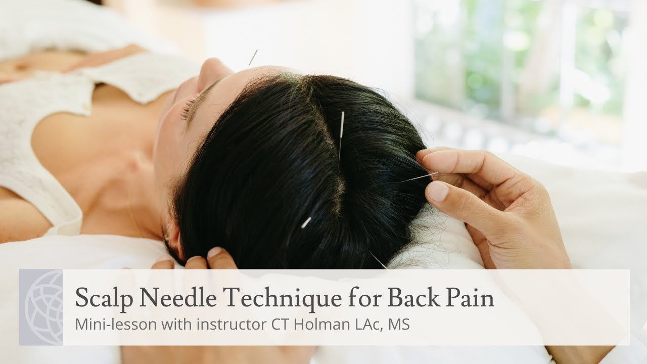 Scalp Needle Technique for Back Pain Minilesson with CT Holman YouTube