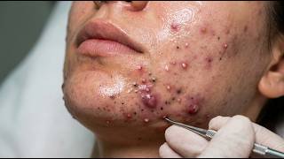 Loan Nguyen Acne Treatment 0ll