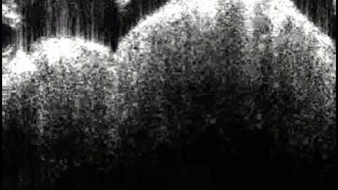 Three-Dimensional Images and Vessel Rendering Using Optical Coherence Tomography 4