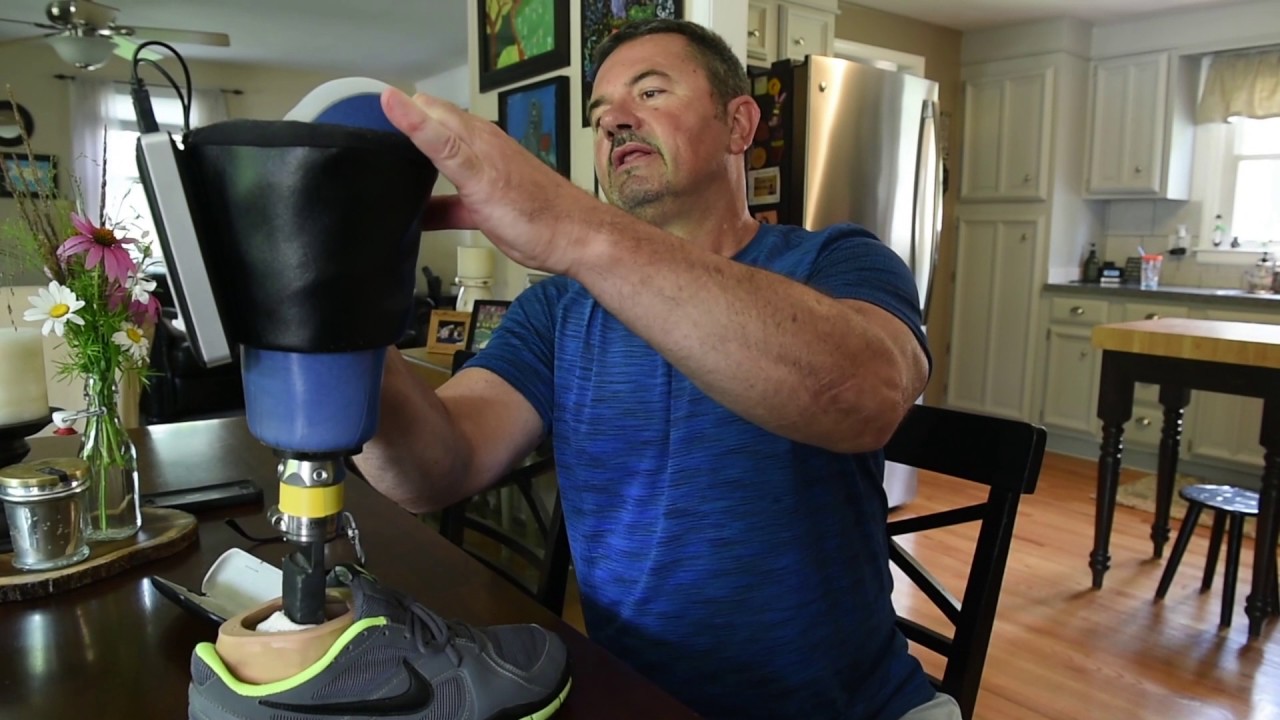 CNY amputee develops prosthetic warmer to battle cold stumps YouTube