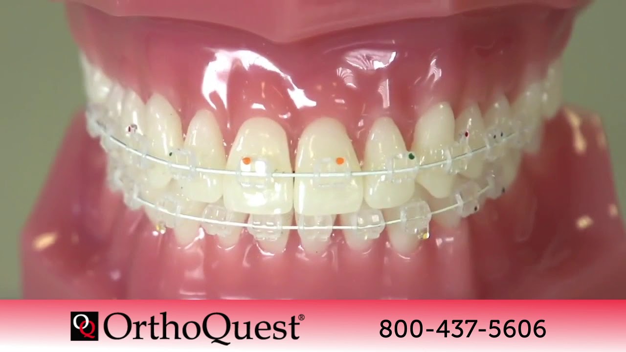 Avair Aesthetic Brackets from OrthoQuest