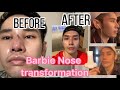 My Rhinoplasty/ Nose Job Journey