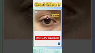 Upper Eyelid Defect in Newborn 👶 | What’s the Diagnosis? #shorts