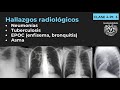 04.3 - Neumonía, TB, EPOC, Enfisema, Bronquitis, Bronquiectasias, Asma