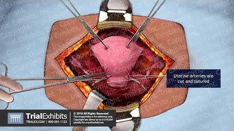 Abdominal Hysterectomy
