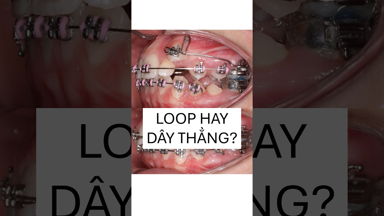 Loop hay dây thẳng để kéo R3 mọc cao trong chỉnh nha? #drthaiortho # ...