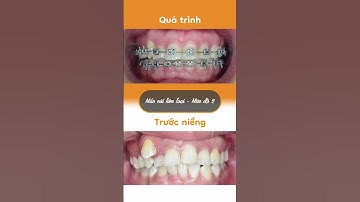 Hành trình LỘT XÁC nhờ niềng răng của Đặng Thị Thanh