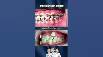 Crowded Teeth Braces - Niềng Răng Chen Chúc | Bác sĩ Trung Long Biên