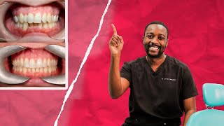 Full Smile Makeover Guide | Invisalign and Composite bonding cases News
