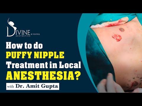 How to do Puffy Nipple Treatment in Local Anesthesia?