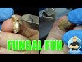 EXTREME BAD NAIL FUNGUS TREATMENT #1 - FOOT HEALTH MONTH 2018 #17