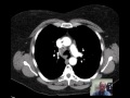 CT Chest Lung Nodule Discussed by Radiologist