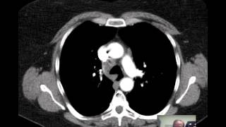 CT Chest Lung Nodule Discussed by Radiologist