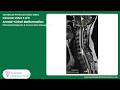 5/6 video- Arnold–Chiari Malformation: Differential Diagnosis &amp; Conservative Management
