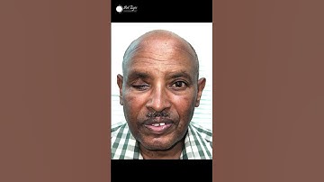 #artificialeye #prostheticeye #aiims #cosmeticeye