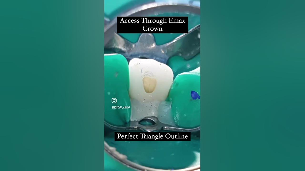 access-cavity-outine-for-upper-lateral-incisor-through-emax-crown