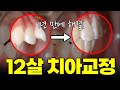 어린이 무턱교정, 늦었다고 느끼면 정말 늦습니다