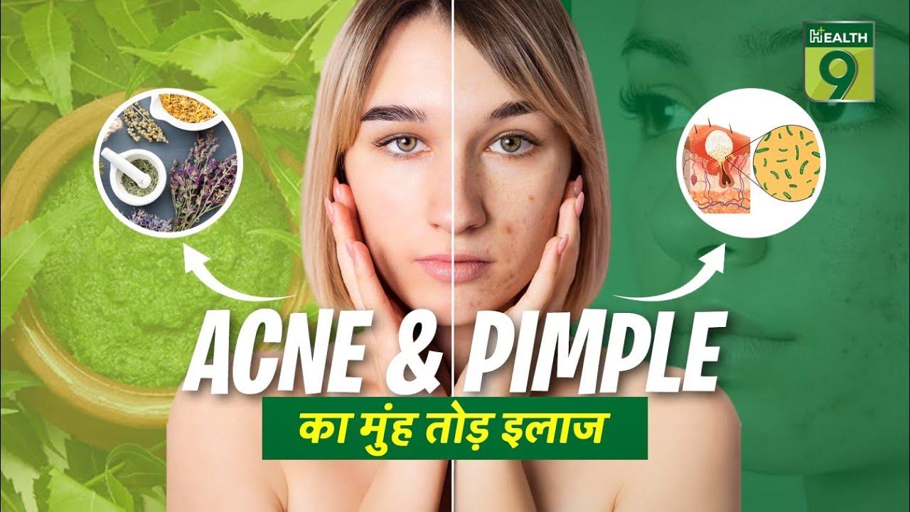 how-to-stop-pimples-coming-on-face-dr-anvika-prevent-facial-pimples