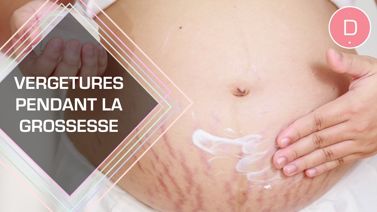 Grossesse et début de vergeture : que faire ?