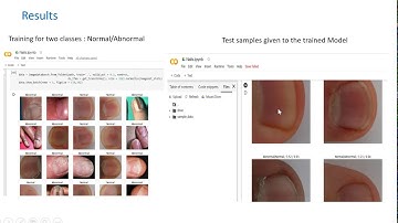 Disease Recognition through  Nails