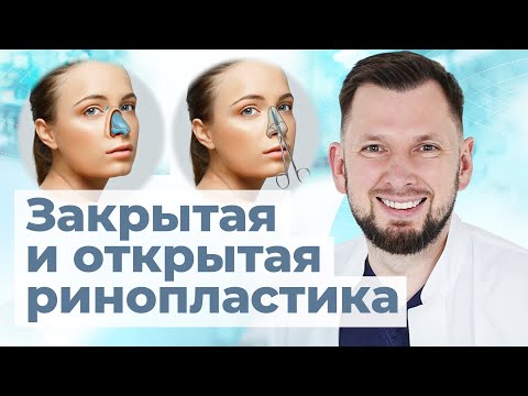 Открытая или закрытая ринопластика? Какой метод пластики носа лучше?