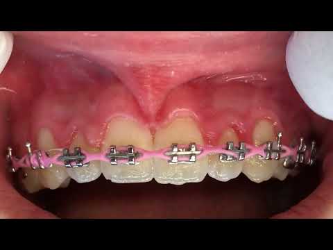 Maxillary Frenectomy on an orthodontic patient using the laser