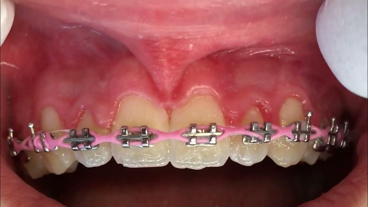 Maxillary Frenectomy on an orthodontic patient using the laser YouTube