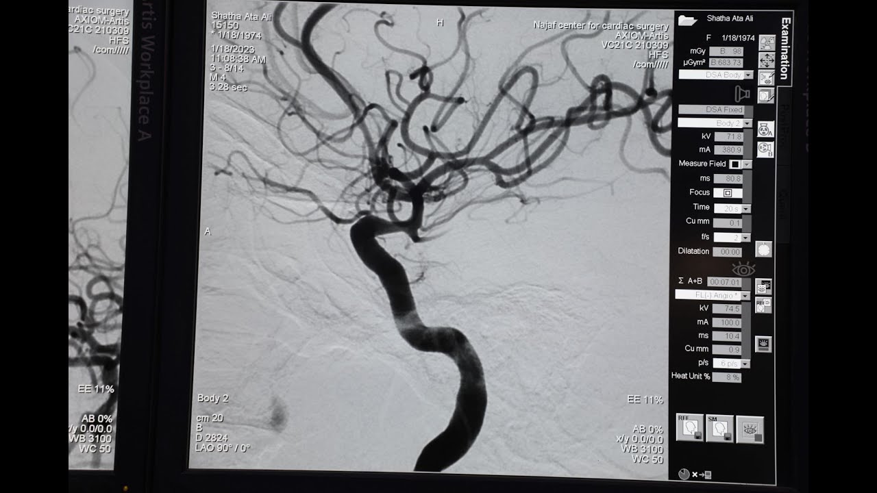 #القسطرة_الدماغية إحدى التداخلات القسطارية التي تجرى في مركز النجف
