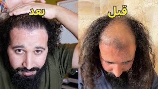 نتيجة عملية زراعة الشعر بعد سنة في تركيا