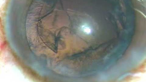 LTT ( Lens Tilt Technique) for Soft Cataracts by P Mohanta, NEH, 16.12.2016