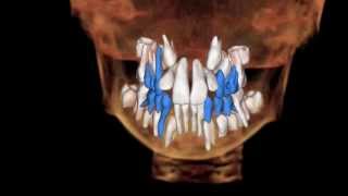 Carlson Orthodontics Podcast - February 2014 - Decrease Orthodontic X-Ray Exposure Using CBCT