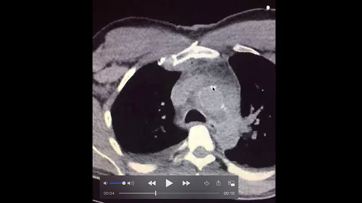 Heart CT scan explained
