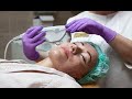 Альтера-терапия (ULTHERAPY) | подтяжка лица без операций