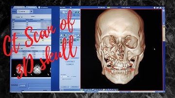 CT Scan 3D skull | CT Scan 3D Face | Fracture | Fungal sinusitis.