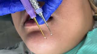 Nebraska vs H6/7 Dental Hygiene Instruments