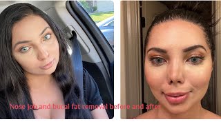 Rhinoplasty and buccal fat removal vlog; recovery and results