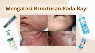 BRUNTUSAN PADA BAYI | BIANG KERINGAT BAYI | ALERGI PADA BAYI | JERAWAT DIKEPALA BAYI | LEHER BERAIR