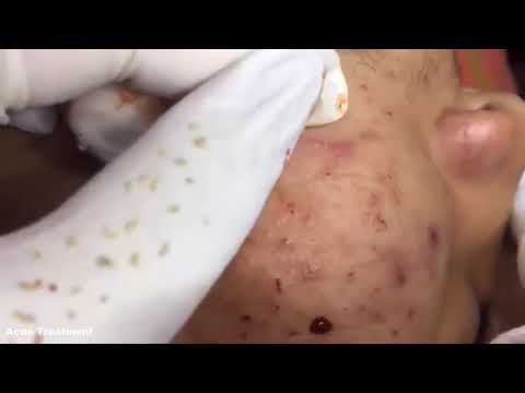 Acne Removal On Cheek And Forehead With Relaxing Music #