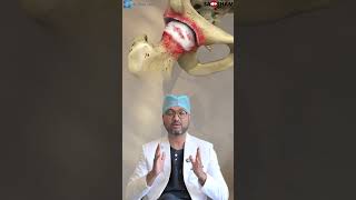 Types of hip arthritis #drdebashishchanda give