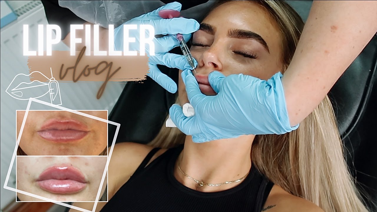 COME WITH ME TO GET LIP FILLER VLOG | MY LIP FILLER EXPERIENCE